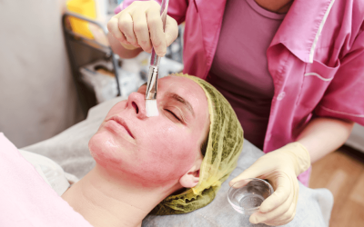 Say Goodbye to Acne Scars: Chemical Peels Near You Can Help